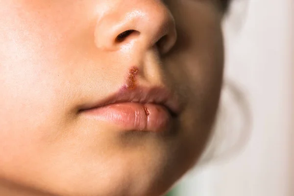 Herpes on upper lip of little girl.  Child with cold sores on her lips.