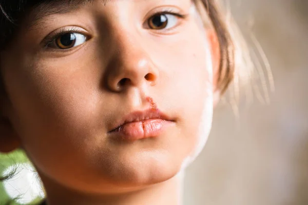 Herpes on upper lip of little girl.  Child with cold sores on her lips.
