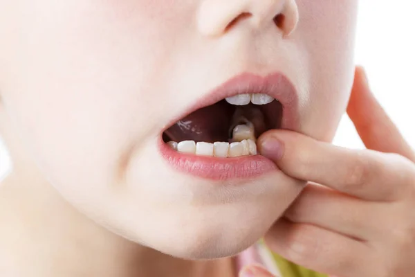 Liten flicka öppnar munnen och visar sjukt tand — Stockfoto
