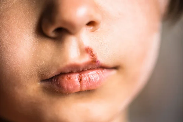 Küçük kızın üst dudağına uçuk. Dudaklarında soğuk sular olan çocuk.