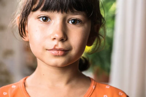 Küçük kızın üst dudağına uçuk. Dudaklarında soğuk sular olan çocuk.