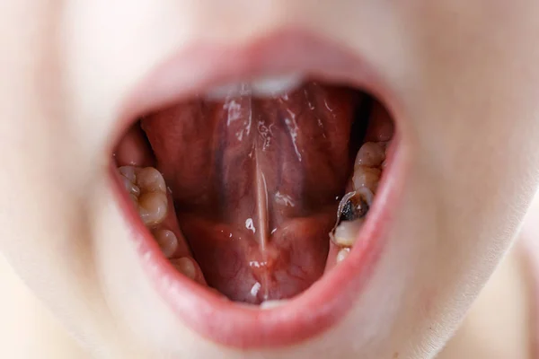 Menina abre a boca e mostra o dente doente — Fotografia de Stock