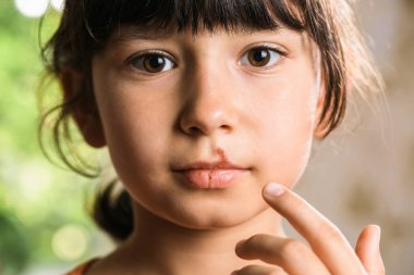 Herpes on upper lip of little girl.  Child with cold sores on her lips. clipart