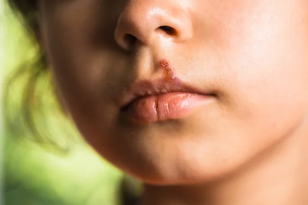 Herpes auf der Oberlippe eines kleinen Mädchens. Kind mit Lippenherpes. — Stockfoto