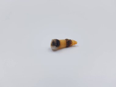 Beyaz arka planda çürük diş çekilmiş.