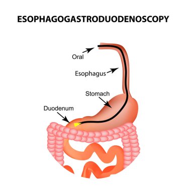 Esophagogastroduodenoscopy. Üst endoskopi. Fibrogastroscopy. Tanısında özofagus, mide, onikiparmak bağırsağı, ince bağırsak, kolon. Vektör illüstrasyon izole arka plan üzerinde