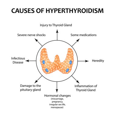 The causes of hyperthyroidism of the thyroid gland. Infographics. Vector illustration on isolated background. clipart