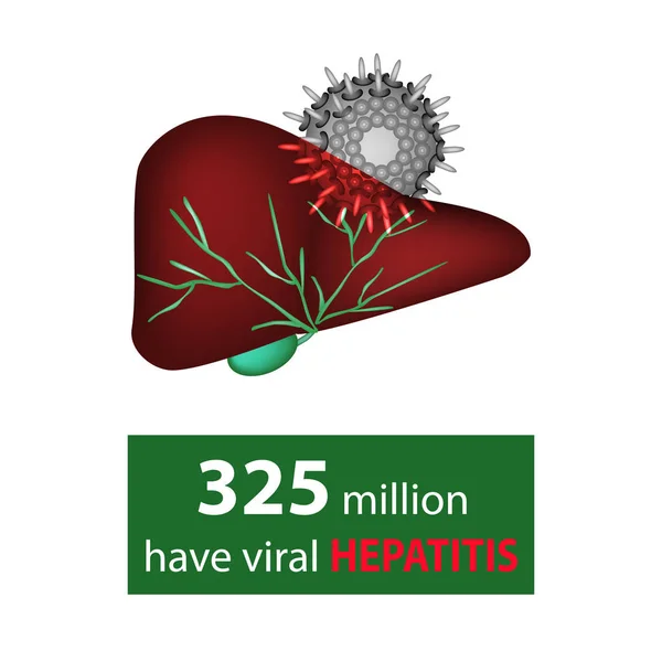 325 millones tienen hepatitis viral. Virus del hígado y la hepatitis. Día Mundial de la Hepatitis. Infografías. Ilustración vectorial sobre fondo aislado . — Vector de stock