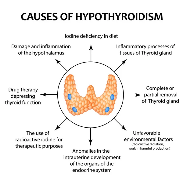 Az oka a hypothyreosis pajzsmirigy. Infographics. Elszigetelt háttér vektor illusztráció. — Stock Vector