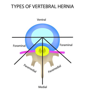 Types of location of the intervertebral hernia. Vector illustration on isolated background. clipart