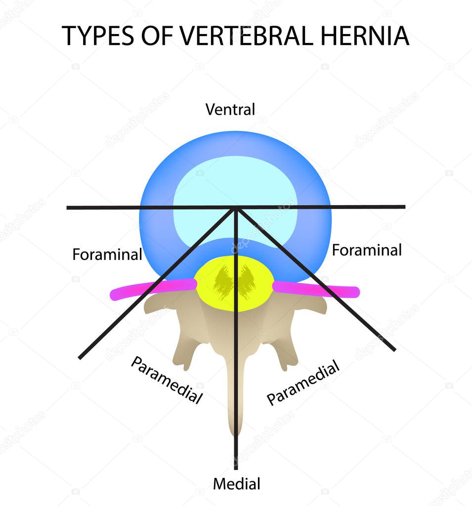 Types of location of the intervertebral hernia. Vector illustration on isolated background.