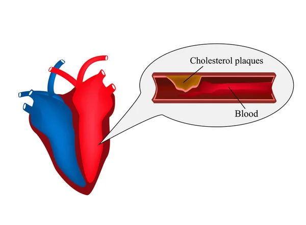 Aterosclerosis del corazón. angina de pecho. Enfermedad cardíaca. Día Mundial del Corazón. Ilustración vectorial sobre fondo aislado . — Archivo Imágenes Vectoriales