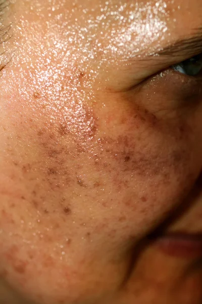 Pigmented spots on the face. Pigmentation on cheeks — Stock Photo, Image