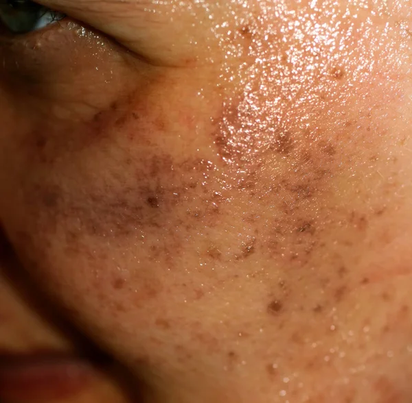 Manchas pigmentadas en la cara. Pigmentación en las mejillas — Foto de Stock