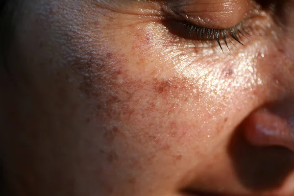 Pigmented spots on the face. Pigmentation on cheeks — Stock Photo, Image