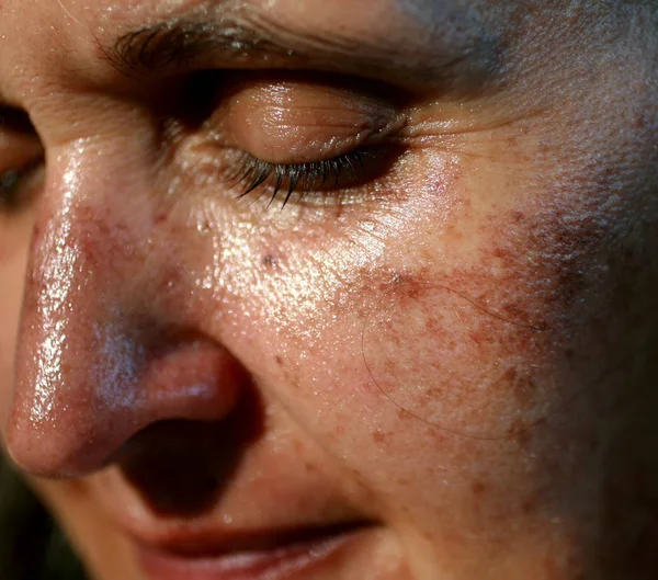 Pigmented spots on the face. Pigmentation on cheeks — Stock Photo, Image