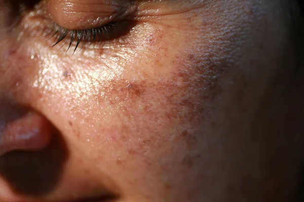 Pigmented spots on the face. Pigmentation on cheeks — Stock Photo, Image