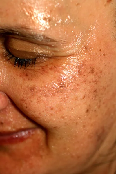 Pigmented spots on the face. Pigmentation on cheeks