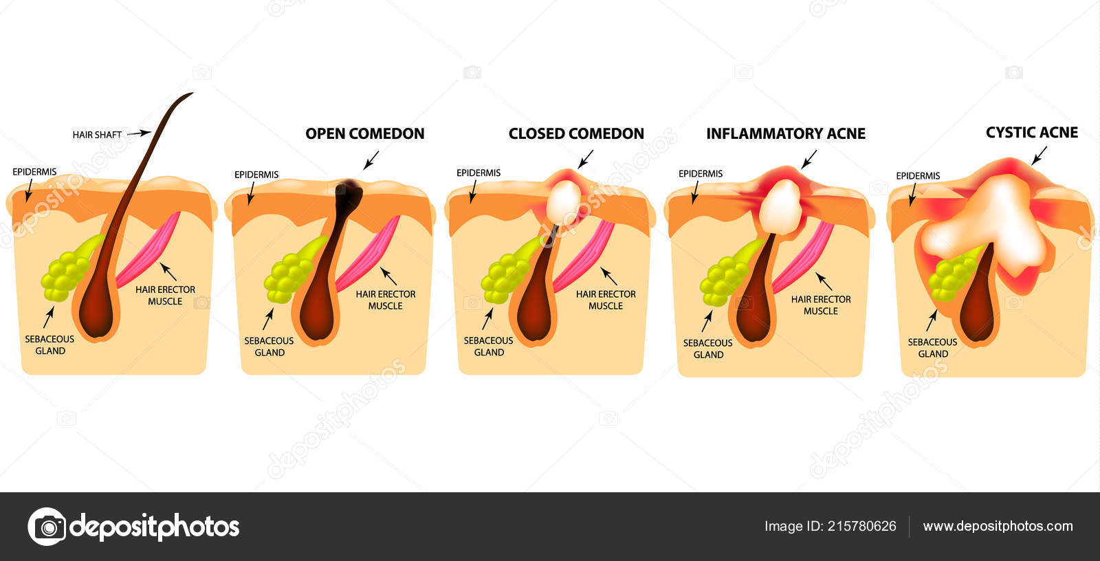 Комидон. Открытые комедоны черные угри. Комедоны схема волосяной фолликул. Камедон угорь подкожный. Комидон.