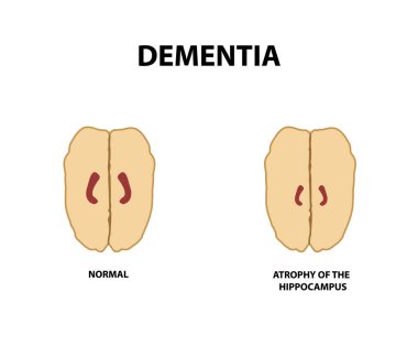 Hipokampus atrofisi. Demans. Alzheimer hastalığı. Vektör illüstrasyon izole bir arka plan üzerinde