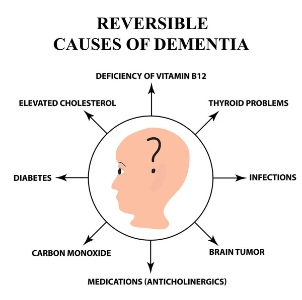 Odwracalne przyczyny demencji starczej. Choroby Alzheimera. Infografiki. Ilustracja wektorowa na na białym tle — Wektor stockowy