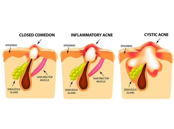 Types van acne. Gesloten comedonen, inflammatoire acne, cystic acne. De structuur van de huid. Infographics. Vectorillustratie op geïsoleerde achtergrond — Stockvector