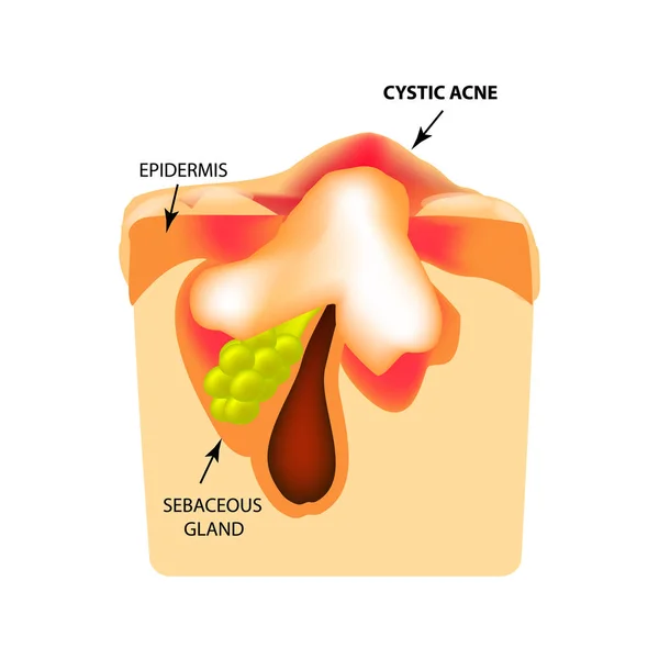 Acne cística. A estrutura da pele. Infográficos. Ilustração vetorial sobre fundo isolado . —  Vetores de Stock