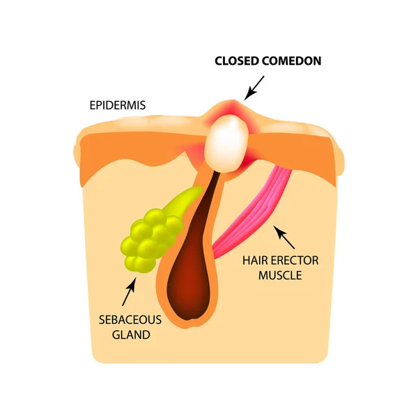 Gesloten comedonen. witte hoofden acne. De structuur van de huid. Infographics. Vectorillustratie op geïsoleerde achtergrond — Stockvector