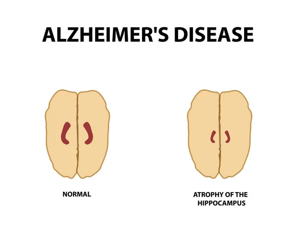 Atrofia hipokampa. Demencji. Choroby Alzheimera. Ilustracja wektorowa na na białym tle — Wektor stockowy