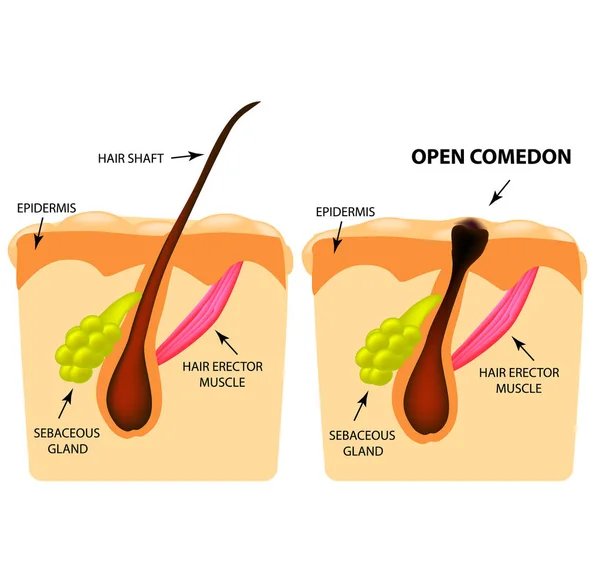 Comedões abertos. acne cabeça preta. A estrutura da pele. Infográficos. Ilustração vetorial sobre fundo isolado . — Vetor de Stock