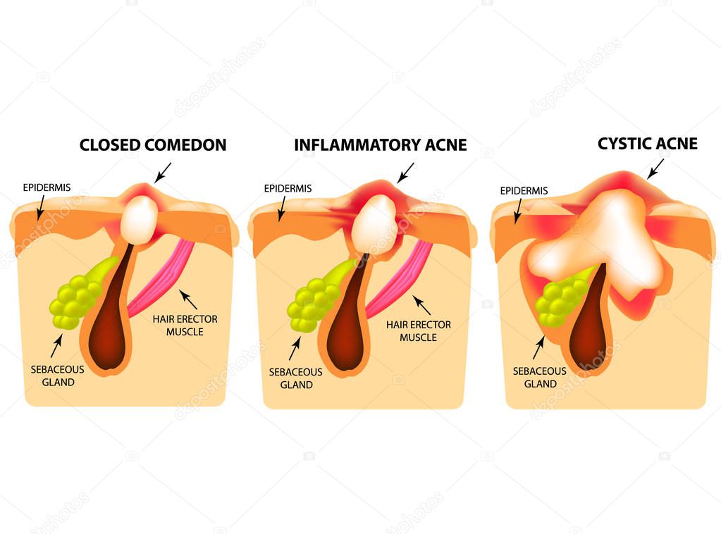 Types of acne. Closed comedones, inflammatory acne, cystic acne. The structure of the skin. Infographics. Vector illustration on isolated background