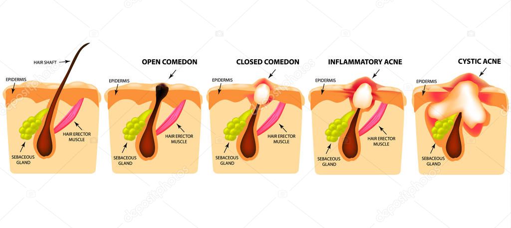Types of acne. Open comedones, closed comedones, inflammatory acne, cystic acne. The structure of the skin. Infographics. Vector illustration on isolated background.