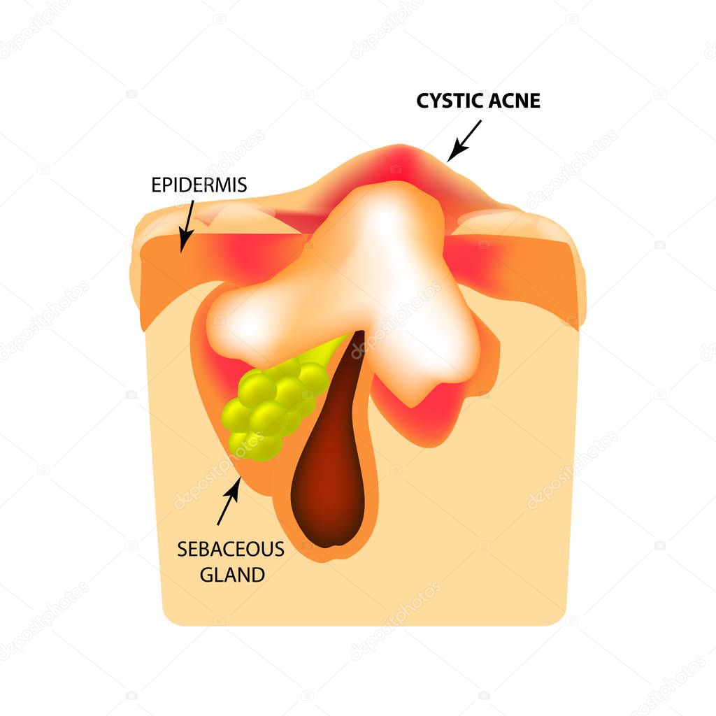 Cystic acne. The structure of the skin. Infographics. Vector illustration on isolated background.