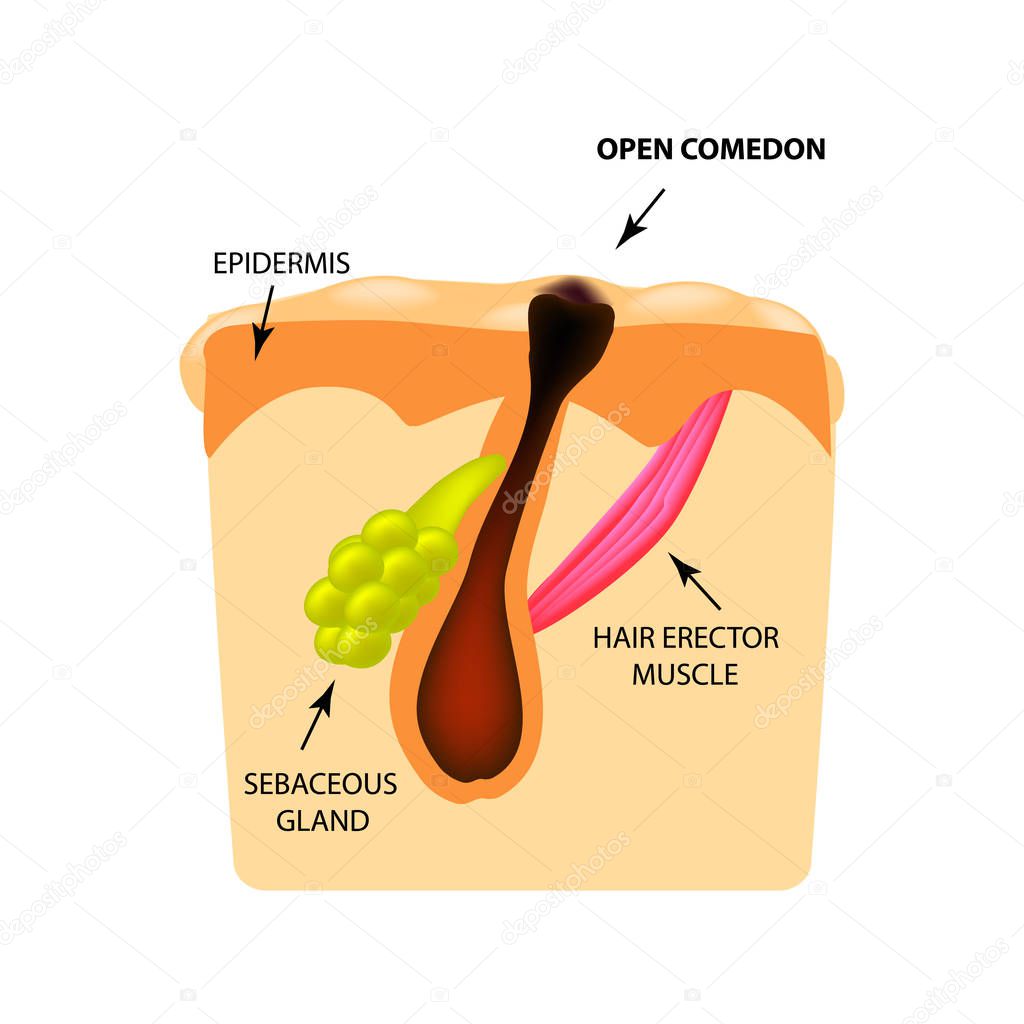 Open comedones. black head acne. The structure of the skin. Infographics. Vector illustration on isolated background.