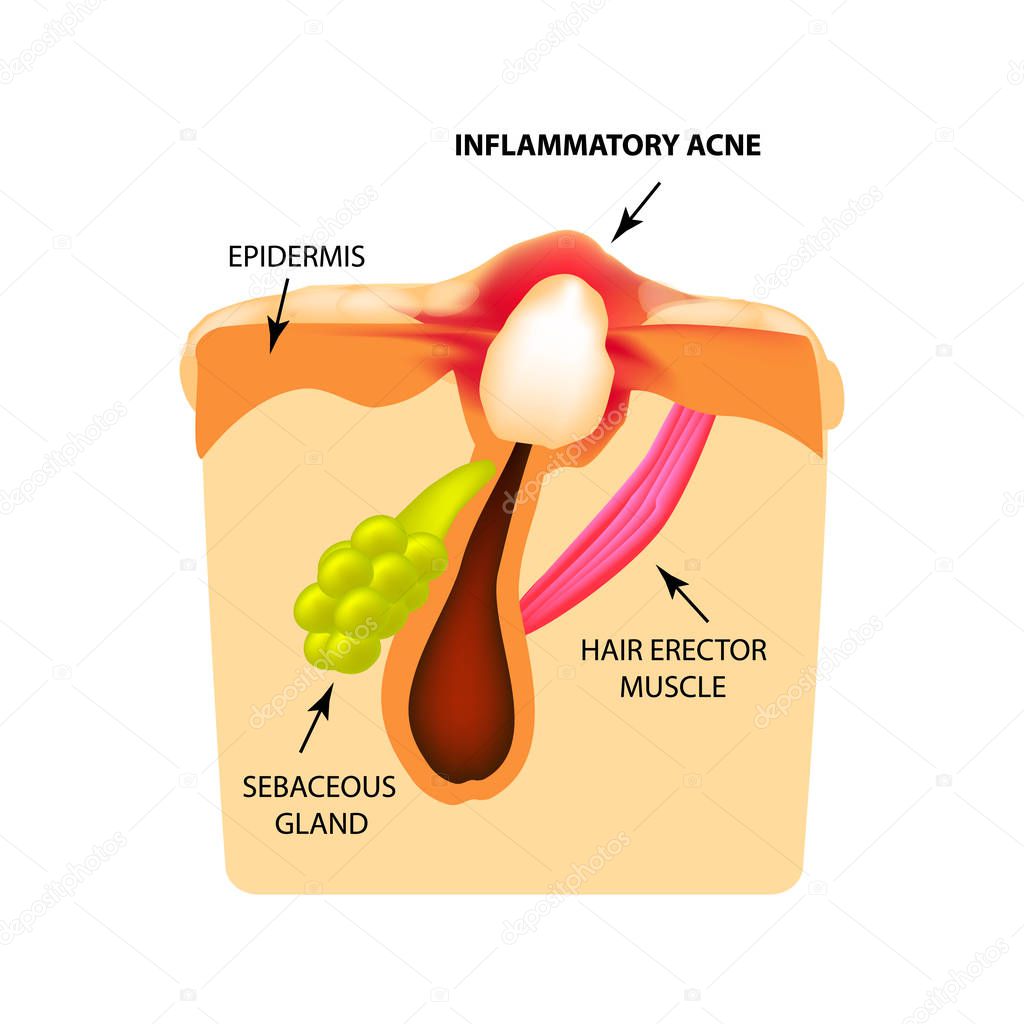Inflammatory comedones. acne. The structure of the skin. Infographics. Vector illustration on isolated background