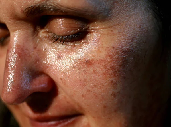 Pigmented spots on the face. Pigmentation on cheeks — Stock Photo, Image