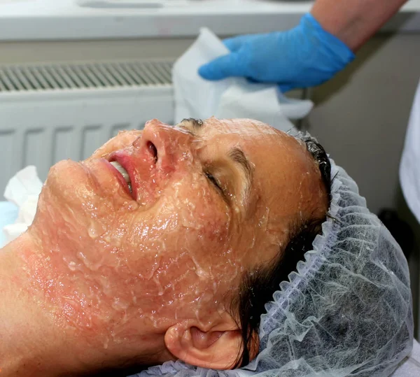 Flicka på det kosmetiska förfarandet. Ansikte rengöring. Fraktionerad föryngring. Botox. Laser resurfacing. Elos lyft. — Stockfoto