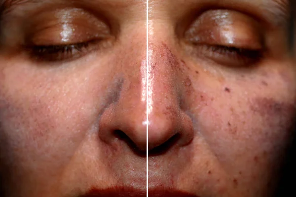 One half of the face in pigmentation and brown spots, the other side of the face after laser polishing and peeling — Stock Photo, Image