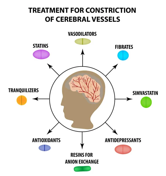 Pengobatan dari cerebral vascular constriction. Hari Stroke Sedunia. Infografis. Ilustrasi vektor pada latar belakang terisolasi - Stok Vektor