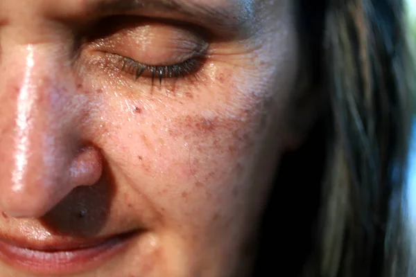 Pigmented spots on the face. Pigmentation on cheeks — Stock Photo, Image