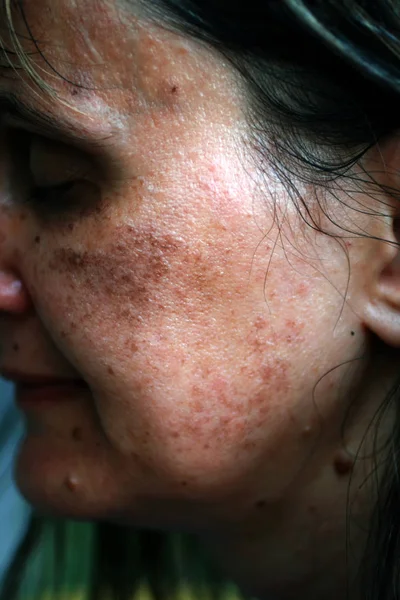 Pigmented spots on the face. Pigmentation on cheeks