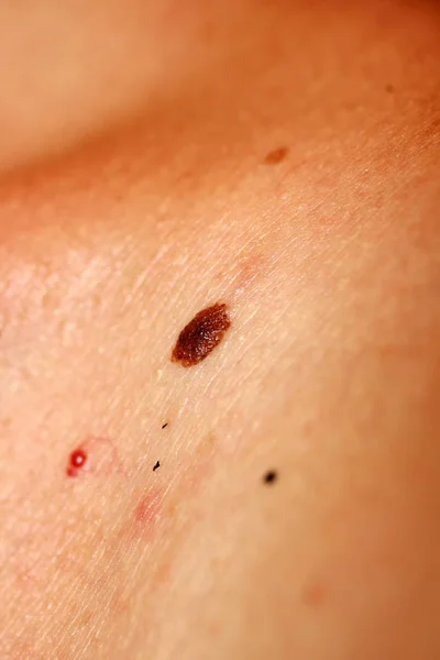 Birthmark marrone. Talpa marrone di grandi dimensioni. Macchia sulla pelle — Foto Stock