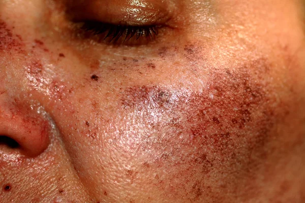 Taches pigmentées sur le visage. Pigmentation sur les joues — Photo