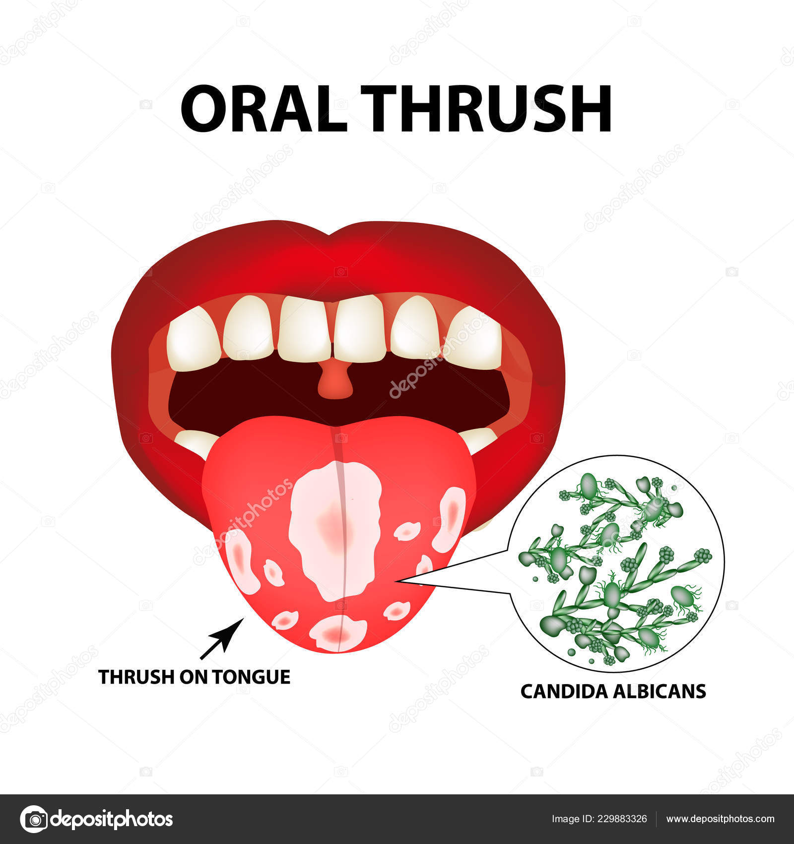 Oral Thrush Candidiasis Tongue Fungus Mouth Infographics Vector