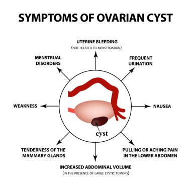 Yumurtalık kisti belirtileri. Yumurtalıkların yapısı. Infographics. Vektör illüstrasyon izole arka plan üzerinde