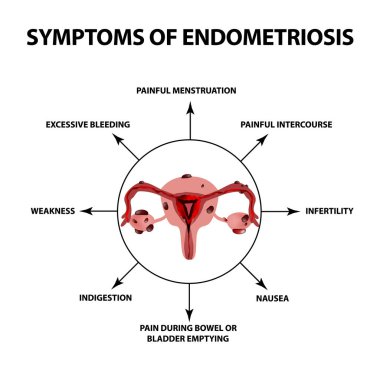 Endometriozis belirtileri. Rahim yumurtalıkların yapısı. Infographics. Vektör illüstrasyon izole arka plan üzerinde.