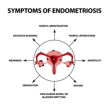 Symptoms of endometriosis. The uterus ovaries structure. Infographics. Vector illustration on isolated background. clipart