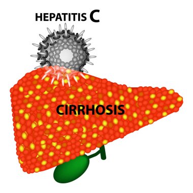Hepatit C Siroz vakalarının yüzde 97'si gelişmesine yol açar. Infographics. Vektör illüstrasyon izole arka plan üzerinde.