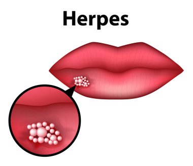 Herpes dudak üzerinde. Infographics. Vektör illüstrasyon izole arka plan üzerinde
