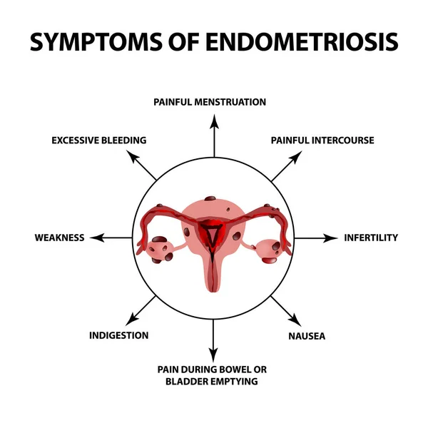 Endometriozis belirtileri. Rahim yumurtalıkların yapısı. Infographics. Vektör illüstrasyon izole arka plan üzerinde.